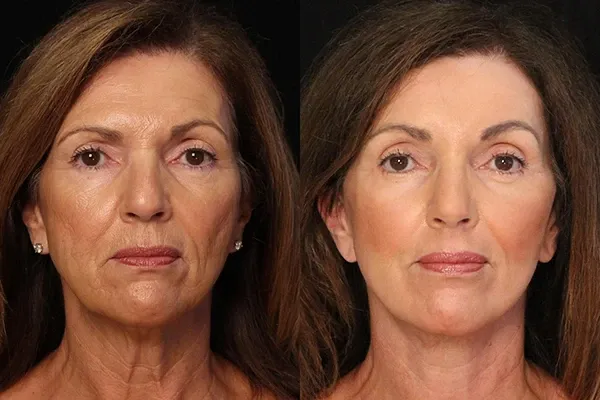 Face lift